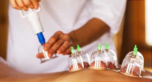 Hijama Cupping Therapy